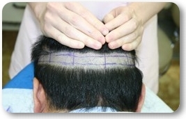 FUTストリップ法の移植毛採取による傷跡